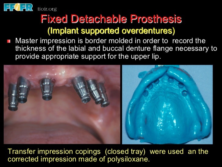 Edentulous Maxilla Fixed Prostheses