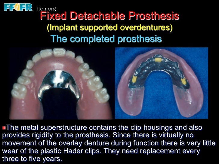 Edentulous Maxilla Fixed Prostheses