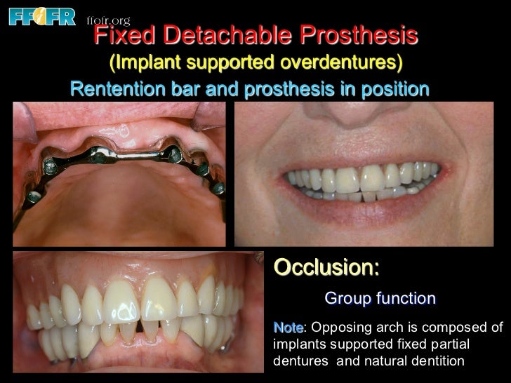 Edentulous Maxilla Fixed Prostheses