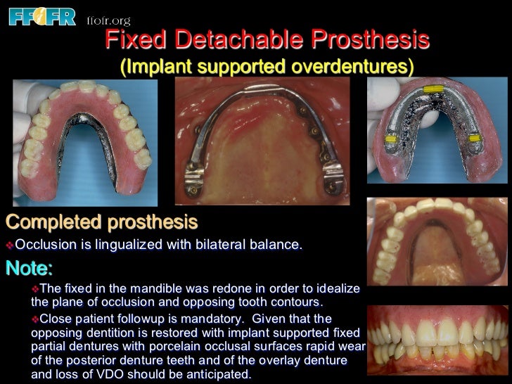 Edentulous Maxilla Fixed Prostheses