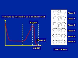 Rafael Llombart Ais - Escoliosis | PDF