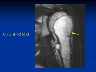Coronal T-2 MRI
 
