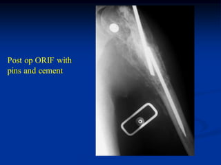 Post op ORIF with
pins and cement
 