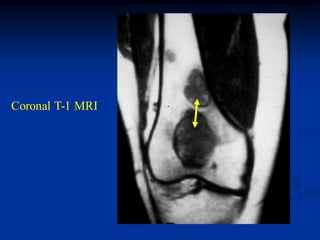 Coronal T-1 MRI
 