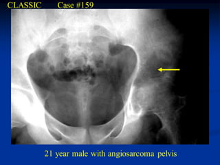 CLASSIC      Case #159




          21 year male with angiosarcoma pelvis
 