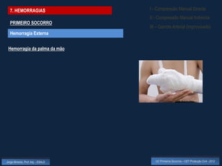 7. HEMORRAGIAS                    I - Compressão Manual Directa
                                    II - Compressão Manual Indirecta
  PRIMEIRO SOCORRO
                                    III – Garrote Arterial (improvisado)
  Hemorragia Externa


 Hemorragia da palma da mão




Jorge Almeida, Prof. Adj. - ESALD      UC Primeiros Socorros – CET Protecção Civil - 2012
 