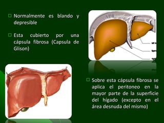 Normalmente es blando y depresible  Esta cubierto por una cápsula fibrosa (Capsula de Glison) Sobre esta cápsula fibrosa se aplica el peritoneo en la mayor parte de la superficie del hígado (excepto en el área desnuda del mismo) 