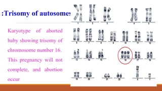 Trisomy of autosomes
:
Karyotype of aborted
baby showing trisomy of
chromosome number 16.
This pregnancy will not
complete, and abortion
occur
 