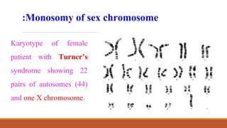 Monosomy of sex chromosome
:
Karyotype of female
patient with Turner’s
syndrome showing 22
pairs of autosomes (44)
and one X chromosome.
 