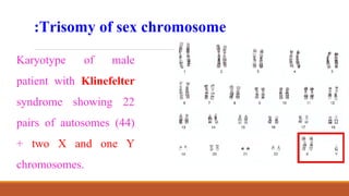 Trisomy of sex chromosome
:
Karyotype of male
patient with Klinefelter
syndrome showing 22
pairs of autosomes (44)
+ two X and one Y
chromosomes.
 