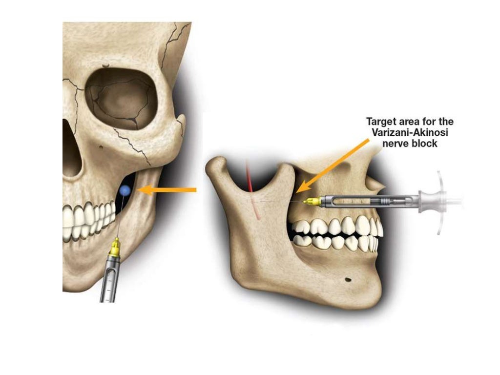 mandibular nerveblock