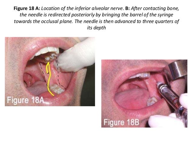 inferior alveolar nerve block