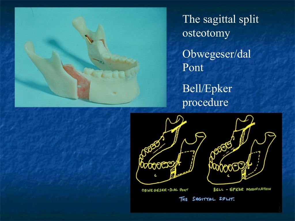 7 mandibular osteotomies