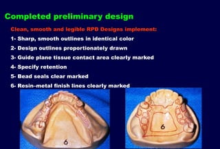 Beading Rpd 7- Mouth and abutment preparation.pptx