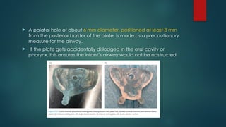 Plate Obstructer NASO ALVEOLAR MOULDNIG IN CLEFT LIP AND PALATE PATIENT | PPTX