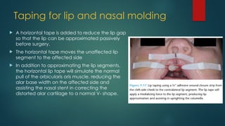 NASO ALVEOLAR MOULDNIG IN CLEFT LIP AND PALATE PATIENT | PPTX