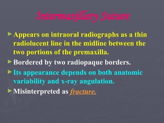 Intermaxillary Suture
►Appears on intraoral radiographs as a thin
radiolucent line in the midline between the
two portions of the premaxilla.
►Bordered by two radiopaque borders.
►Its appearance depends on both anatomic
variability and x-ray angulation.
►Misinterpreted as fracture.
 