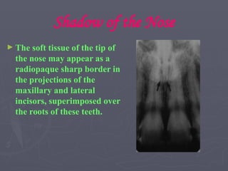 Shadow of the Nose
► The soft tissue of the tip of
the nose may appear as a
radiopaque sharp border in
the projections of the
maxillary and lateral
incisors, superimposed over
the roots of these teeth.
 