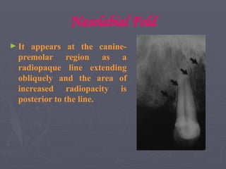 Nasolabial Fold
► It appears at the canine-
premolar region as a
radiopaque line extending
obliquely and the area of
increased radiopacity is
posterior to the line.
 