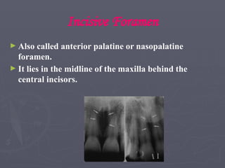 Incisive Foramen
► Also called anterior palatine or nasopalatine
foramen.
► It lies in the midline of the maxilla behind the
central incisors.
 