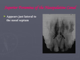 Superior Foramina of the Nasopalatine Canal
► Appears just lateral to
the nasal septum
 