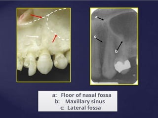 a: Floor of nasal fossa
b: Maxillary sinus
c: Lateral fossa
a
b
c
 