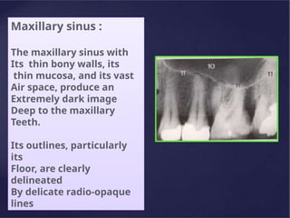 Maxillary sinus :
The maxillary sinus with
Its thin bony walls, its
thin mucosa, and its vast
Air space, produce an
Extremely dark image
Deep to the maxillary
Teeth.
Its outlines, particularly
its
Floor, are clearly
delineated
By delicate radio-opaque
lines
 