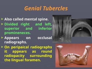 Genial Tubercles
► Also called mental spine.
► Divided right and left,
superior and inferior
promineneces.
► Appears on occlusal
radiographs.
► On peripaical radiographs
it appears as round
radiopacity surrounding
the lingual foramen.
 