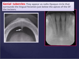 Genial tubercles: They appear as radio Opaque circle that
surrounds the lingual foramen just below the apices of the Of
the incisors.
 
