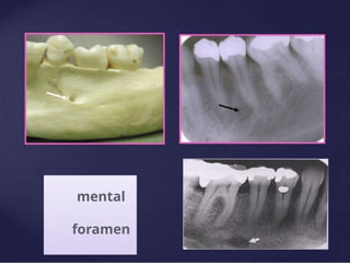 mental
foramen
 