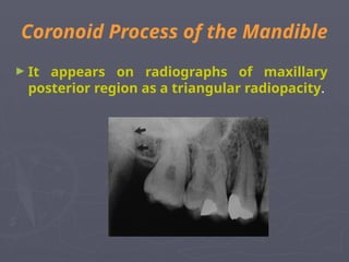 Coronoid Process of the Mandible
► It appears on radiographs of maxillary
posterior region as a triangular radiopacity.
 