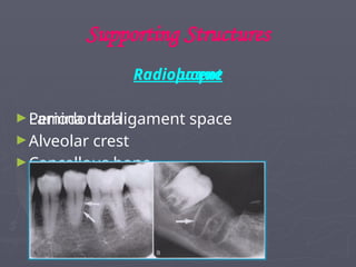 Supporting Structures
Radiolucent
►Periodontal ligament space
Radiopaque
►Lamina dura
►Alveolar crest
►Cancellous bone
 