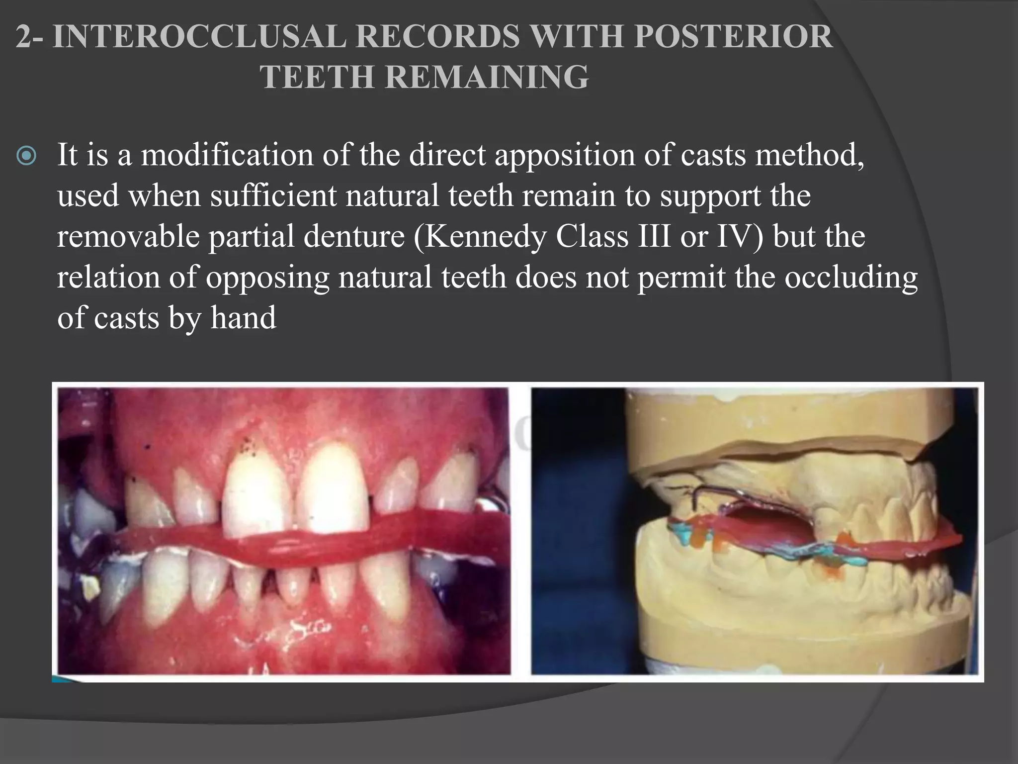 Occlusal Record Rpd Occlusion in Removable Partial Dentures | PPT