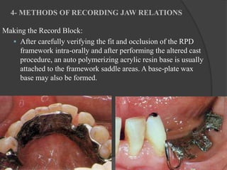 Occlusal Record Rpd Occlusion in Removable Partial Dentures | PPTX