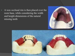 Occclusal Rims Occlusion in Removable Partial Dentures | PPTX