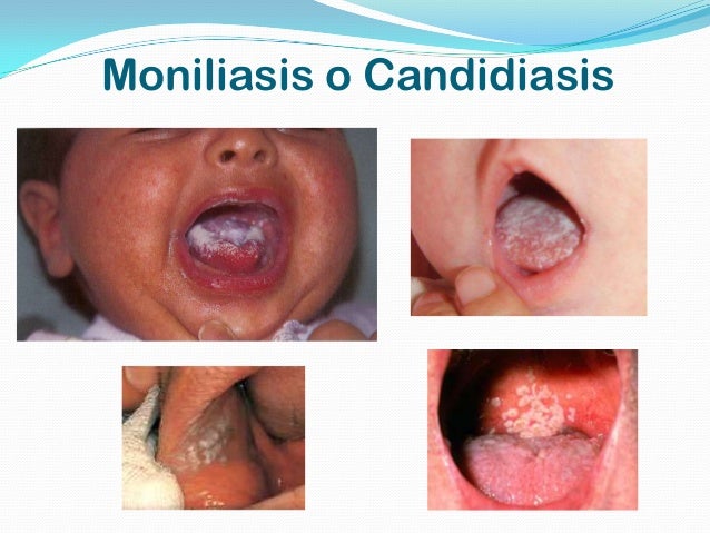 moniliasis