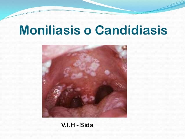 moniliasis