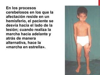 En los procesos cerebelosos en los que la afectación reside en un hemisferio, el paciente se desvía hacia el lado de la lesión; cuando realiza la marcha hacia adelante y atrás de manera alternativa, hace la «marcha en estrella».  