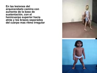 En las lesiones del arquicerebelo camina con aumento de la base de sustentación, con el hemicuerpo superior hacia atrás y los brazos separados del cuerpo mas ritmo irregular  