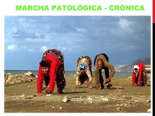MARCHA PATOLÓGICA - CRÓNICA 