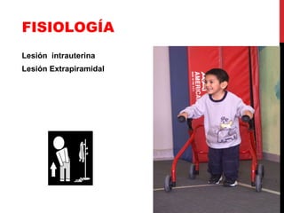 FISIOLOGÍA Lesión  intrauterina Lesión Extrapiramidal 