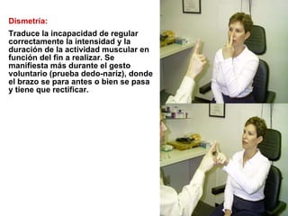 Dismetría:  Traduce la incapacidad de regular correctamente la intensidad y la duración de la actividad muscular en función del fin a realizar. Se manifiesta más durante el gesto voluntario (prueba dedo-nariz), donde el brazo se para antes o bien se pasa y tiene que rectificar. 