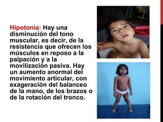 Hipotonía:  Hay una disminución del tono muscular, es decir, de la resistencia que ofrecen los músculos en reposo a la palpación y a la movilización pasiva. Hay un aumento anormal del movimiento articular, con exageración del balanceo de la mano, de los brazos o de la rotación del tronco. 
