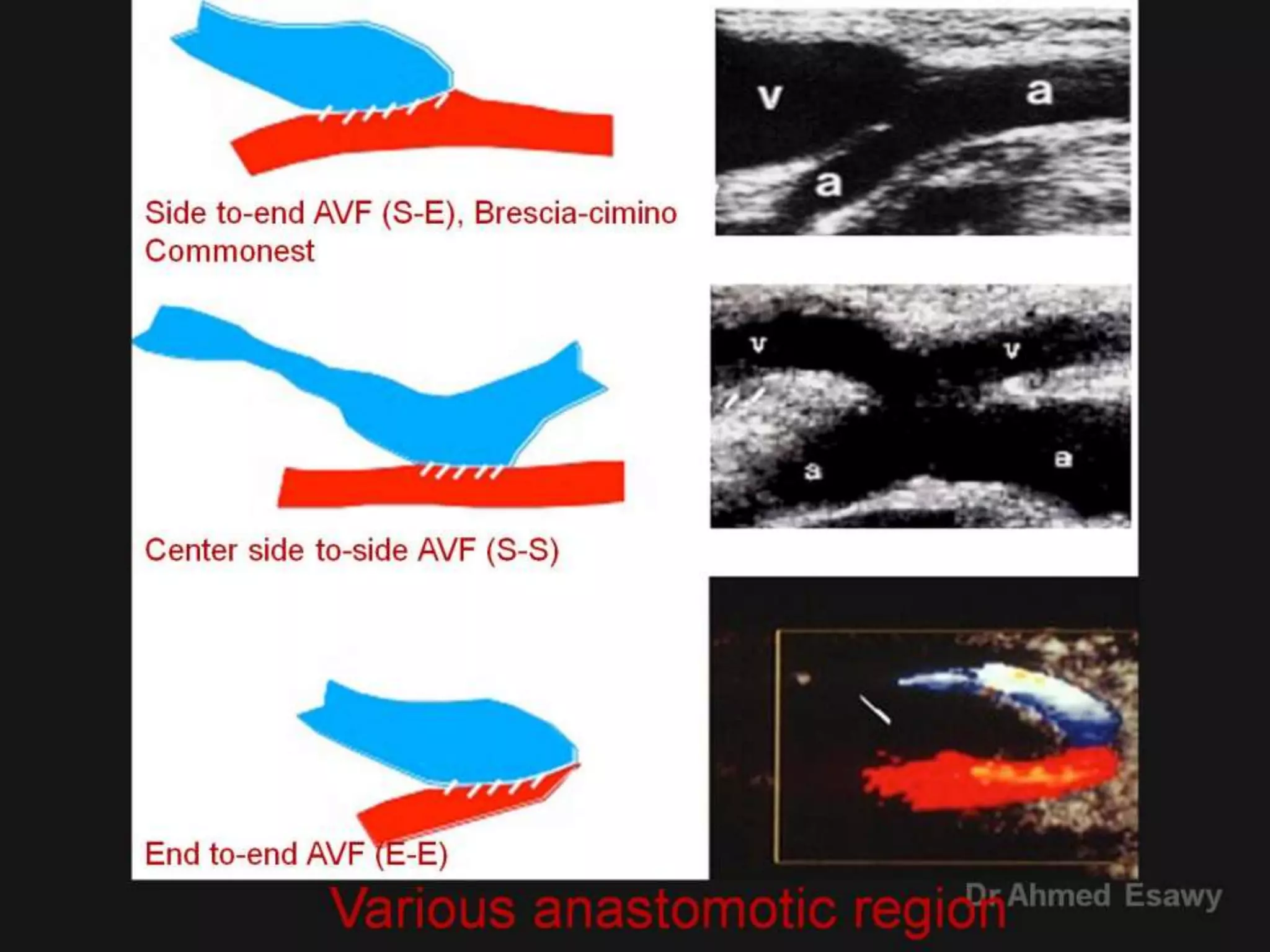 7 peripheral arterial triplex ultrasound dialysis avf triplex ...