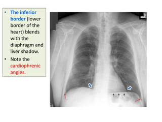 7- Radiological Anatomy of Thorax....pdf