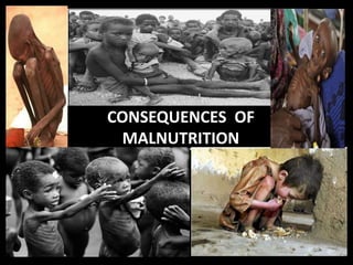 CONSEQUENCES OF
MALNUTRITION
CONSEQUENCES OF
MALNUTRITION
 
