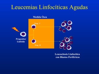 Progenitor
Linfoide
Prog. T
Prog. B
Medúla Ósea
Leucocitosis Linfocítica
con Blastos Periféricos
Leucemias Linfocíticas Agudas
 