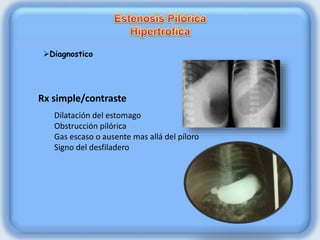 Rx simple/contraste
Dilatación del estomago
Obstrucción pilórica
Gas escaso o ausente mas allá del píloro
Signo del desfiladero
Diagnostico
 