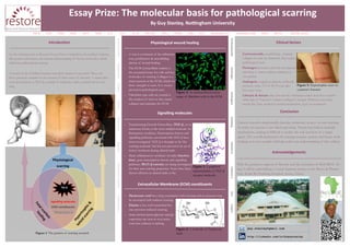 Essay Prize: The molecular basis for pathological scarring
By Guy Stanley, Nottingham University
guy.stanley@gmail.com
http://linkedin.com/in/drguystanley
Introduction
As the winning entry in Restore’s Essay Prize Competition for medical students,
this poster summarises our current understanding of the key molecules, which
influence pathological scarring.
A search of the PubMed database revealed a pattern to research: There are
three principle variables in the context of three areas of research. A major play-
er in the literature is TGF-β, a family of molecules with a central role in scar-
ring.
Conclusion
Current research simplistically classifies molecules as pro– or anti-scarring.
In reality the picture is less black and white. Nature has built in multiple
mechanisms, making it difficult to isolate the sole function of a single
agent. The overall mechanism for scarring remains unclear and future work
looking at in vivo models will help refine our understanding of this subject.
Physiological wound healing
 A scar is a remnant of the inflamma-
tory, proliferative & remodelling
phases of wound healing.
 The ECM (extracellular matrix) is
the structural home for cells and key
molecules of scarring. Collagen is a
major protein in the ECM, which en-
dows strength to scars. It is overex-
pressed in pathological scars.
 Fibroblast type cells are central to
the creation of scars as they create
collagen and maintain the ECM.
Acknowledgements
With the generous support of Restore and the assistance of ReSURGE Af-
rica, I will be undertaking a 5 week Summer project at the Burns & Plastics
Unit, Korle Bu Teaching Hospital, Accra, Ghana.
Extracellular Membrane (ECM) constituents
 Hyaluronic acid has a long association with scarring and its presence may
be associated with reduced scarring.
 Elastin is less well researched but
may promote reduced scarring.
 Some distinct proteoglycans and gly-
coproteins are seen in over active
scars but evidence is lacking.
Clinical factors
 Corticosteroids, in pathology , degrade
collagen in scars. In treatment, they reduce
pathological scars.
 Oestrogen decreases after the menopause
and there is some evidence relating it to
scar quality.
 Androgens, surging at puberty, indirectly
promote Acne. 1% of 18-70 year olds
have acne scars.
 Lifestyle & disease play a broad role. Smoking renders scars less vascular
while lack of Vitamin C reduces collagen’s strength. Without some trace
metals like Zinc, needed in wound metabolism, scars are weakened.
Physiological
scarring
TGF-β
Signalling molecules
ECM constituents
Signalling molecules
 Transforming Growth Factor-Beta (TGF-β), in its
numerous forms, is the most studied molecule. In-
flammatory cytokines, Transcription factors and
signalling pathways, associated with TGF-β have
been investigated. TGF-β is thought to be ‘the
scarring molecule’ but has not proved to be an ef-
fective treatment during clinical trials.
 Many inflammatory cytokines (notably Interleu-
kins), gene transcription factors and signalling
pathways (WnT/β-catenin) are being investigated
for their anti-scarring properties. None have been
shown effective in clinical trials so far.
Figure 1: The pattern of scarring research
Figure 3: A graphical
representation of TGF-β
receptor molecule.
Figure 2: An immunofluorescence
image of fibroblast cells in the ECM
Figure 4: A molecule of Hyaluronic
Acid.
Figure 5: Hypertrophic scars on
a patient’s forearm.
 