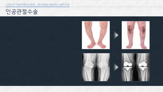 [삼성서울병원] 퇴행성 관절염 6편